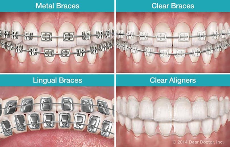 Dental Braces