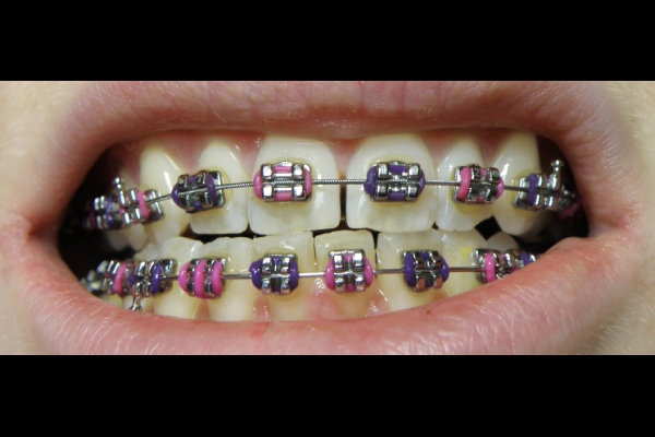 Dental Braces
                